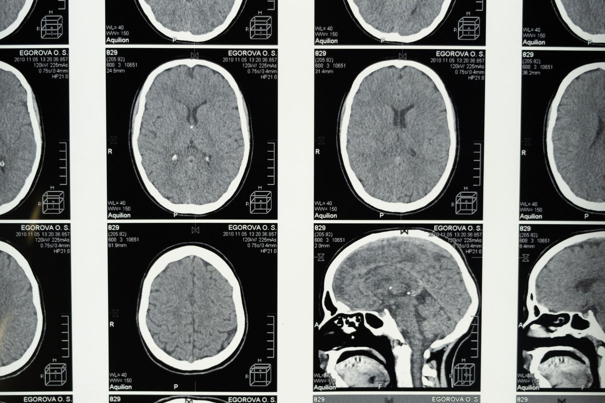 Placas de resonancia magnética del cerebro