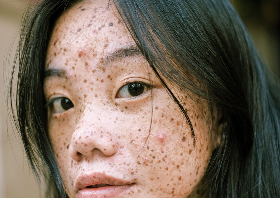 Primer plano de una piel con pecas y manchas